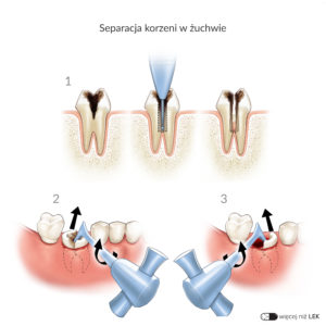 Kopia LDEK Chirurgia stomatologiczna Ekstrakcje – Separacja korzeni w żuchwie