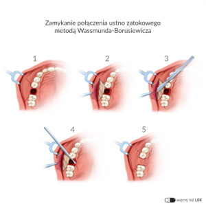 Kopia LDEK Chirurgia stomatologiczna Powikłania – Zamykanie połączenia ustno zatokowego metodą Wassmunda-Borusiewicza