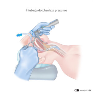 LEK Anestezjologia – Intubacja dotchawicza przez nos