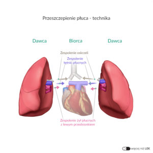 LEK Chirurgia Transplantologia – Przeszczepienie płuca – technika