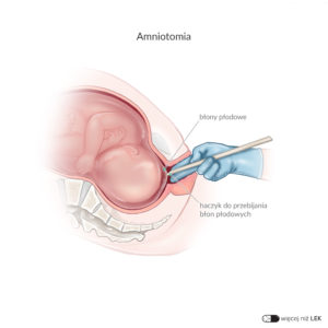 LEK Ginekologia Położnictwo – Amniotomia