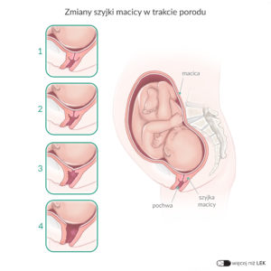 LEK Ginekologia Położnictwo – Zmiany szyjki macicy w trakcie porodu
