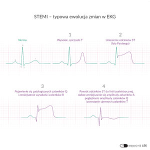 LEK Kardiologia – STEMI – typowa ewolucja zmian w EKG