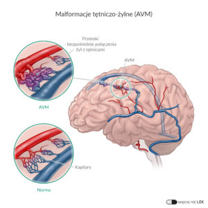 LEK Neurochirurgia – Malformacje tętniczo-żylne (AVM)