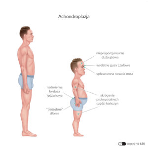 LEK Pediatria – Achondroplazja