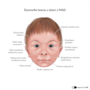 LEK Psychiatria – Dysmorfia twarzy u dzieci z FASD (1)