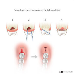 LDEK Periodontologia Zabiegi Procedura zmodyfikowanego dystalnego klina