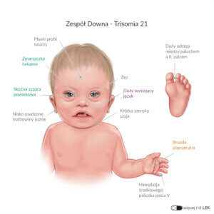 LEK Pediatria Downa Trisomia 21